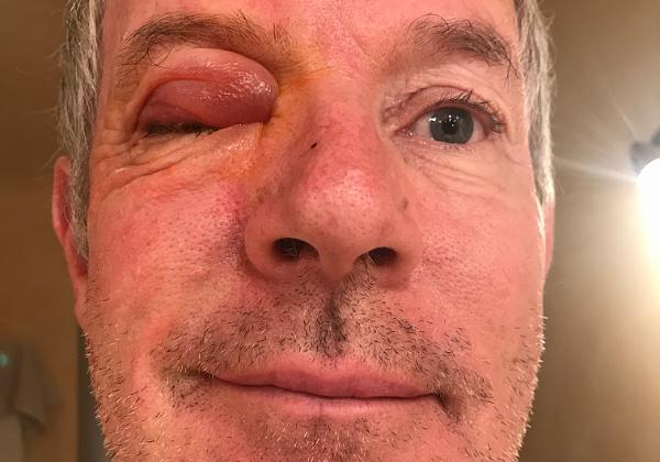 Eye (Friday, 29. June 2018) A swollen eye so short before vacation - ahhh